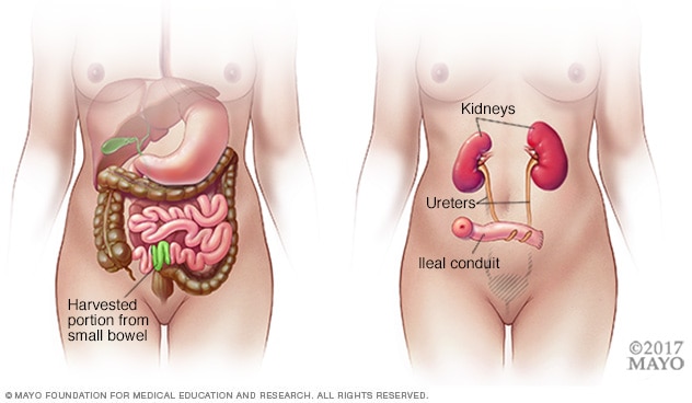 Illustration showing part of small intestine used for ileal conduit surgery.