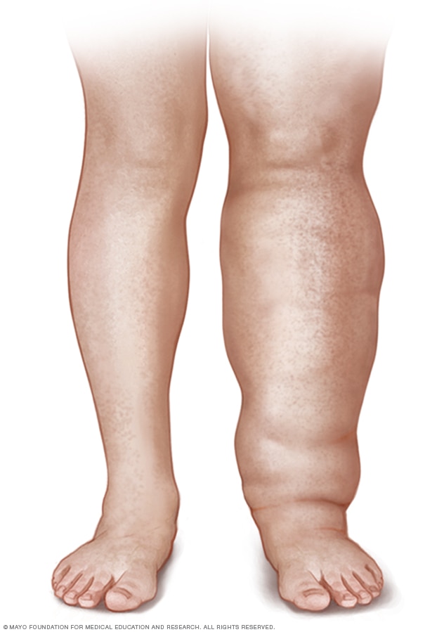 Persona con linfedema en la pierna