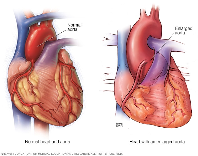 Illustration of aneurysm at aortic root.