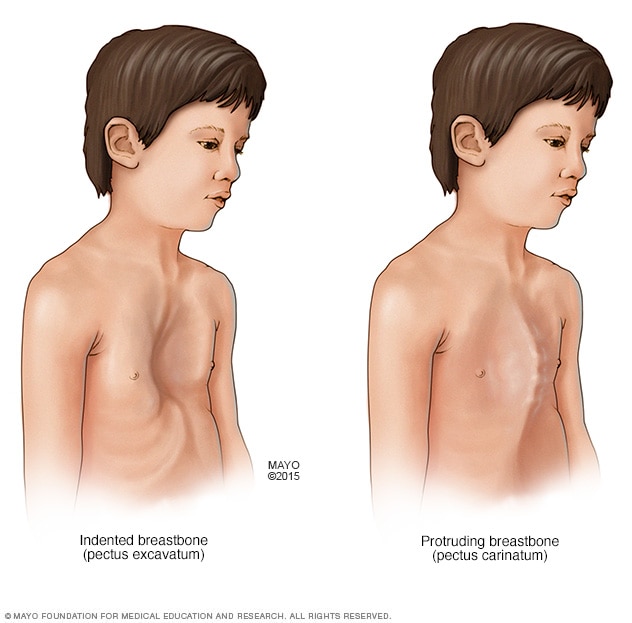 Illustration showing chest changes.