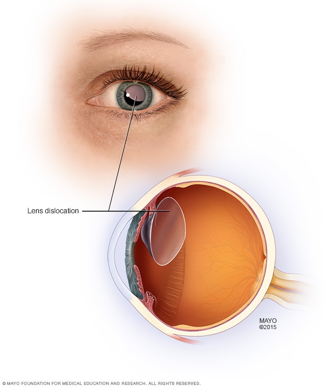 Illustration of a dislocated lens within the eye.
