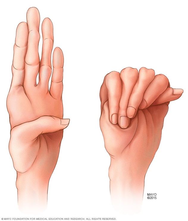 Illustration of long fingers common in Marfan syndrome.