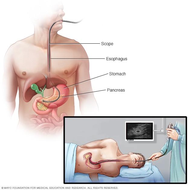 Dispositivo de ecografía insertado a través de un endoscopio en el abdomen.