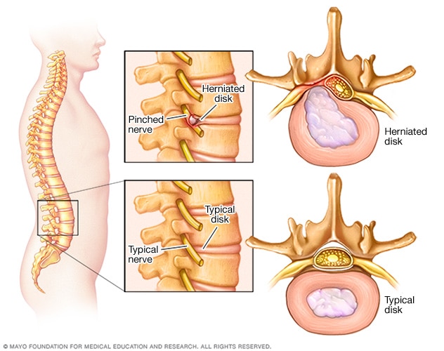 Pinched nerve in spine