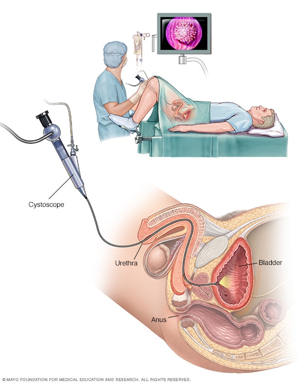 Male cystoscopy exam