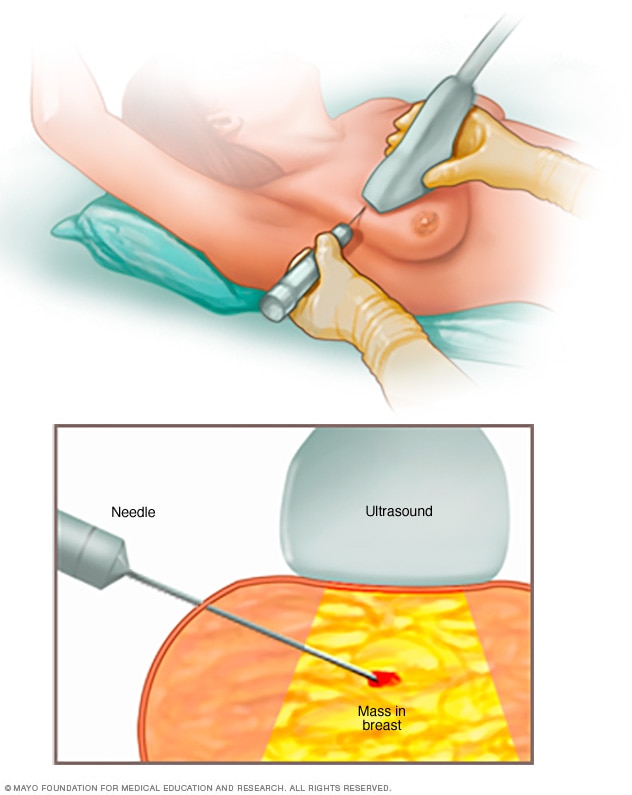 Breast biopsy
