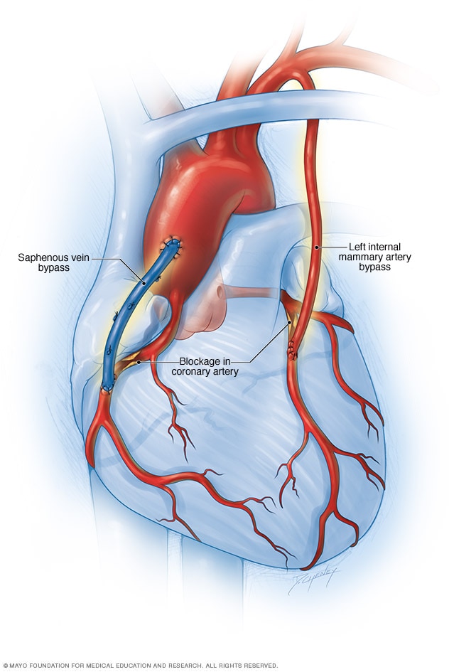 Illustration of coronary artery bypass surgery showing new blood vessel paths around a blocked heart artery.