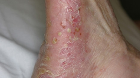 Psoriasis pustulosa