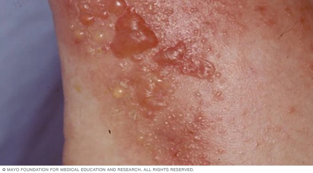 Allergic contact dermatitis