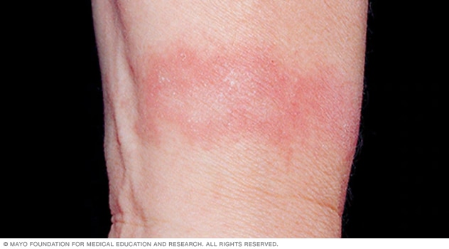 Irritant contact dermatitis