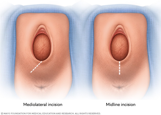 Illustration of an episiotomy