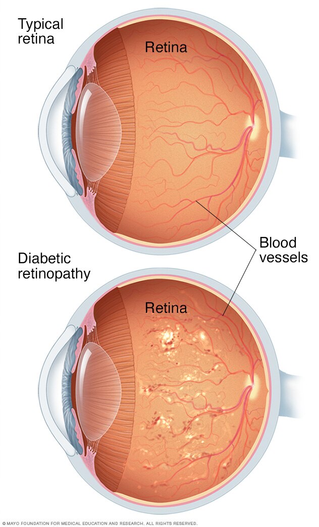 Diabetic Retinopathy Symptoms Causes Risk And Prevention Samuel 