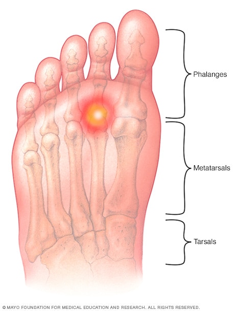 Painful feet clearance