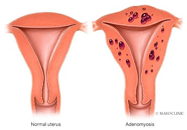 Ilustración comparativa de un útero típico y un útero con depósitos de tejido de adenomiosis
