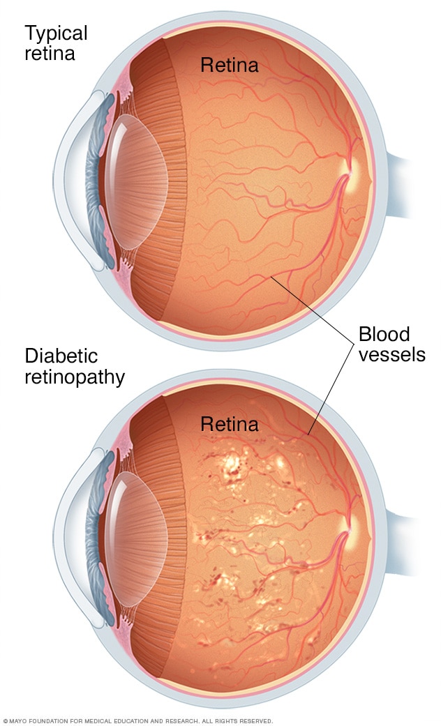 Ilustración de una retinopatía diabética no proliferativa grave
