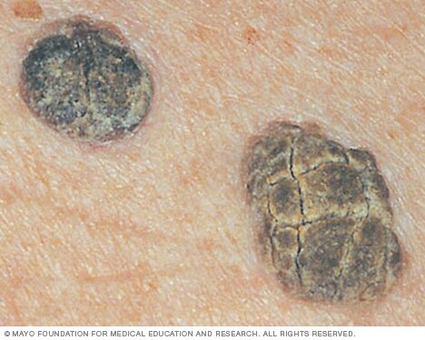 Seborrheic Keratosis Symptoms Causes Mayo Clinic