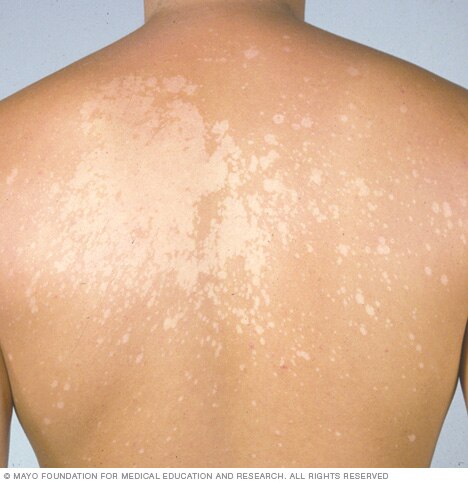 Tinea Versicolor Symptoms Causes Mayo Clinic