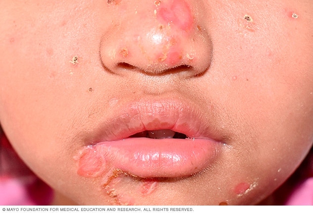 Impetigo Symptoms Causes Mayo Clinic