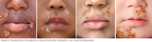 Impetigo Symptoms Causes Mayo Clinic