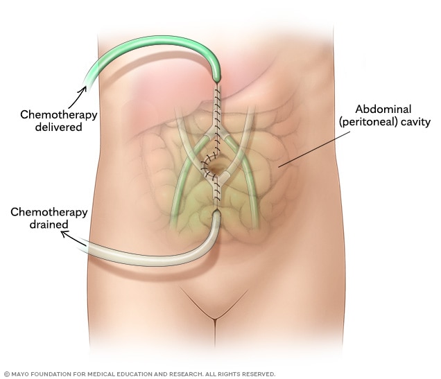 After surgery, the abdominal cavity is rinsed with heated chemotherapy to destroy remaining cancer cells, then drained away.